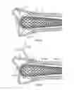 Fig. 43 - Apparatus and methods for fracture repair