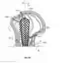 Fig. 49 - Apparatus and methods for fracture repair