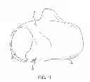 Fig. 12 - Unicompartmental customized arthroplasty cutting jigs