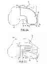 Fig. 17 - Unicompartmental customized arthroplasty cutting jigs