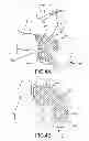 Fig. 19 - Unicompartmental customized arthroplasty cutting jigs