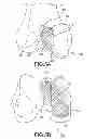 Fig. 20 - Unicompartmental customized arthroplasty cutting jigs