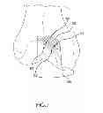 Fig. 22 - Unicompartmental customized arthroplasty cutting jigs