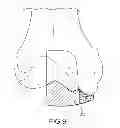 Fig. 24 - Unicompartmental customized arthroplasty cutting jigs