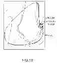 Fig. 25 - Unicompartmental customized arthroplasty cutting jigs