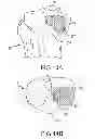 Fig. 31 - Unicompartmental customized arthroplasty cutting jigs