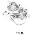 Fig. 32 - Unicompartmental customized arthroplasty cutting jigs