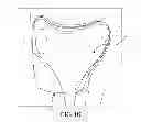 Fig. 33 - Unicompartmental customized arthroplasty cutting jigs