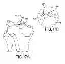 Fig. 34 - Unicompartmental customized arthroplasty cutting jigs