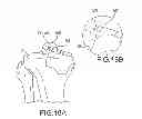 Fig. 35 - Unicompartmental customized arthroplasty cutting jigs