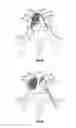 Fig. 26 - Methods and apparatus for treating vertebral fractures