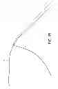 Fig. 16 - Suture snare with retractable sleeve