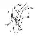 Fig. 01 - Methods for treating a gastrointestinal tract