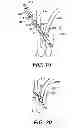 Fig. 10 - Methods for treating a gastrointestinal tract