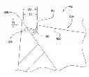 Fig. 01 - Tissue-removing catheter with rotatable cutter