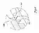 Fig. 07 - Cutting balloon catheter having flexible atherotomes