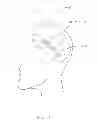Fig. 02 - IMPLANT FOR ANEURYSM TREATMENT