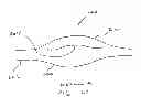 Fig. 04 - IMPLANT FOR ANEURYSM TREATMENT