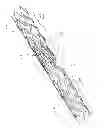 Fig. 06 - IMPLANT FOR ANEURYSM TREATMENT