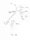 Fig. 45 - IMPLANT FOR ANEURYSM TREATMENT