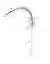 Fig. 02 - DILATATION SYSTEM FOR A MEDICAL DEVICE