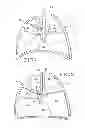 Fig. 02 - Removable anchored lung volume reduction devices and methods