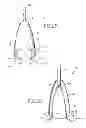 Fig. 04 - Removable anchored lung volume reduction devices and methods