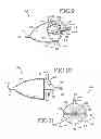 Fig. 07 - Removable anchored lung volume reduction devices and methods