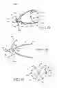 Fig. 08 - Removable anchored lung volume reduction devices and methods