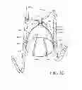 Fig. 09 - Removable anchored lung volume reduction devices and methods