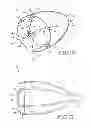 Fig. 10 - Removable anchored lung volume reduction devices and methods