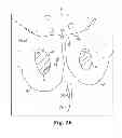 Fig. 28 - System and method of anchoring support material to tissue