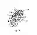 Fig. 02 - Bone anchored surgical mesh