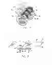 Fig. 04 - Bone anchored surgical mesh