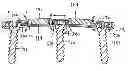 Fig. 01 - Bone plate system