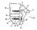 Fig. 01 - Facet joint prosthesis