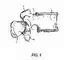 Fig. 02 - Facet joint prosthesis
