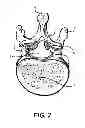 Fig. 03 - Facet joint prosthesis