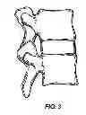 Fig. 04 - Facet joint prosthesis