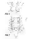 Fig. 06 - Facet joint prosthesis