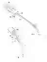 Fig. 04 - Bone fixation rod and implantation device for insertion thereof