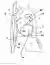 Fig. 01 - IMPLANTED CARDIAC DEVICE FOR DEFIBRILLATION