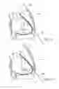 Fig. 06 - IMPLANTED CARDIAC DEVICE FOR DEFIBRILLATION