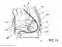 Fig. 08 - IMPLANTED CARDIAC DEVICE FOR DEFIBRILLATION