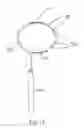 Fig. 09 - IMPLANTED CARDIAC DEVICE FOR DEFIBRILLATION