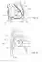 Fig. 11 - IMPLANTED CARDIAC DEVICE FOR DEFIBRILLATION