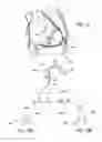 Fig. 13 - IMPLANTED CARDIAC DEVICE FOR DEFIBRILLATION