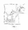 Fig. 02 - Fixation and strain relief element for temporary therapy delivery device