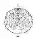 Fig. 04 - Electrode array device configured for placement inside the dura for direct spinal cord stimulation