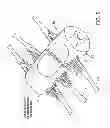 Fig. 07 - Electrode array device configured for placement inside the dura for direct spinal cord stimulation